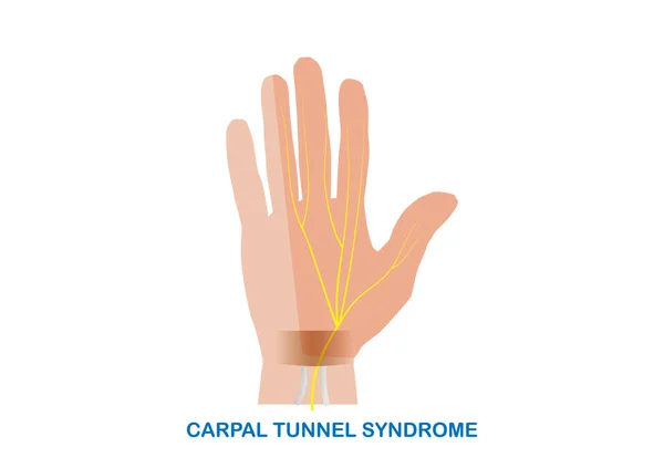 Illustration Vectorielle Piégeage Nerveux Médian Niveau Poignet Syndrome Canal Carpien — Image vectorielle