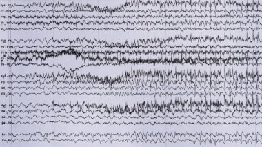 Imaging of ictal EEG recording in epilepsy patient during monitoring.	