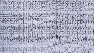Imaging of ictal EEG recording in epilepsy patient during monitoring.	
