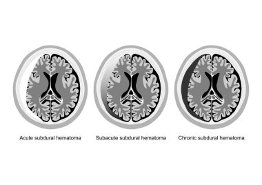 Stages of subdural hematoma brain injury illustrated clipart