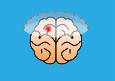 Beynin belirli bir bölgesini hedef alan odaklı ultrason tedavisi, nörolojik hastalıklar için zararsız bir terapiyi temsil ediyor.. 