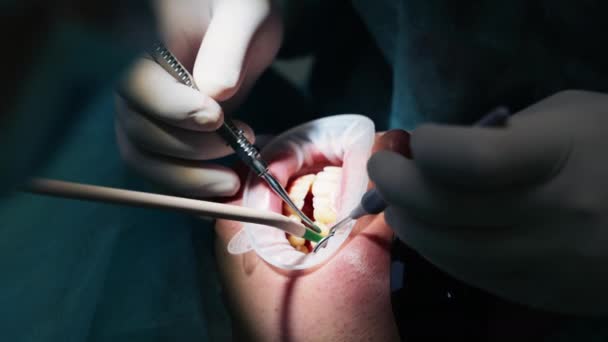 Reiniging Behandeling Van Tanden Met Medische Instrumenten Een Tandheelkundige Kliniek — Stockvideo