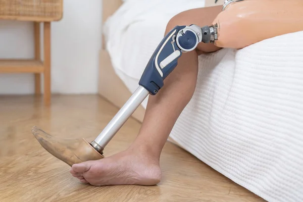 寝室のベッドに座っている切断された脚を持つ女性の義足の閉鎖 義足の関節とメカニズムを示しています — ストック写真