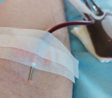 blood donor with big needle stuck in forearm during donation at hospital
