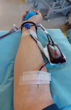 blood donor arm with big needle in arm during donation at hospital