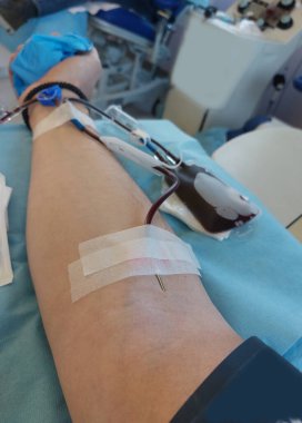 blood donor arm with big needle in arm during donation at hospital