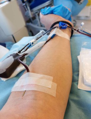 blood donor arm with needle in the arm during donation