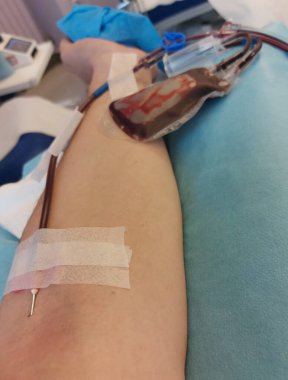 Kan nakli sırasında koluna iğne saplanmış beyaz bir adam.