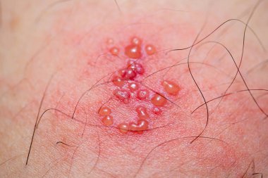 Deride kızarıklık ve kabarcıklar (Zona, herpes zoster))