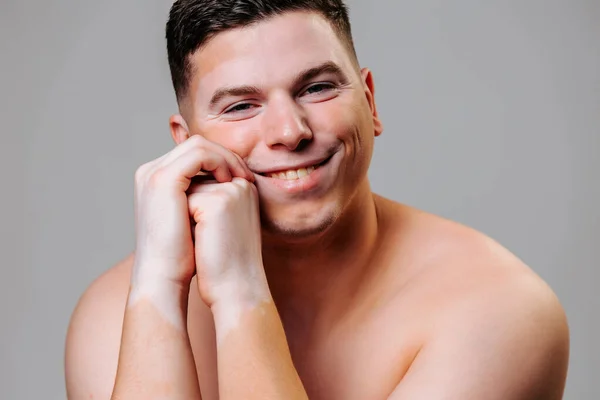 Young man shows condition of skin with a vitiligo disorder while smiling at the camera. Vitiligo of the skin is a disease that does not prevent you from working and living a normal life. Studio shot