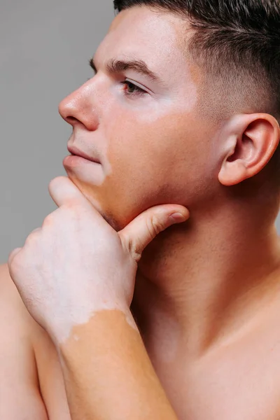 The unchanging natural body image of a young man with vitiligo does not prevent him from being successful in life portrait. Varied pattern of skin makes it unusual and different from everyone else.