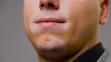 Gri bir arka plan stüdyo çekiminde vitiligo taşıyan genç bir adamın yüzünün ön tarafını kapatın. Pigmentasyon, beyaz noktalar, genetik hastalıklar, deri sorunları, pigment kaybı, sorun çözüldü.