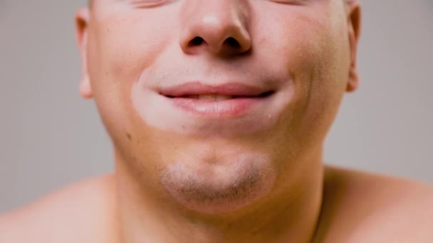 Simetrik Depigmentasyon Mutlu Görünüş Hayattan Memnun Olan Genç Bir Adamın — Stok video