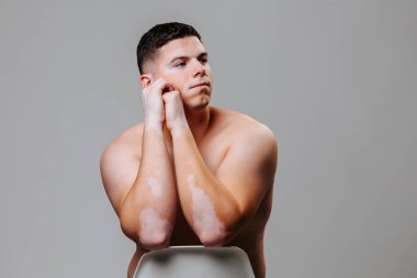 Vitiligo 'su olan genç bir adamın portresi cildindeki kusurları gösteriyor ve kendini öyle kabul ediyor. Deri hastalığı olan insanlara karşı tolerans kavramı. Stüdyo görüntüsü gri arkaplan öngörünümü