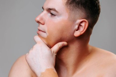 A profile portrait of a non standard young guy with vitiligo, he says that he is handsome. The concept of accepting yourself in any form and image is the key to success. Studio shot, gray background. clipart