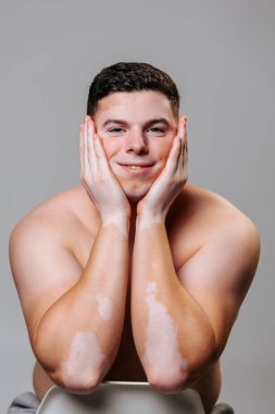 Yüzündeki Vitiligo için endişelenmeye gerek yok, gerçek insanlar cilt hastalıklarını göstermekten korkmazlar. Stüdyoda cesurca duran genç bir adam vitiligo hastalığıyla nasıl yaşanacağını gösteriyor. Kollar yüze..