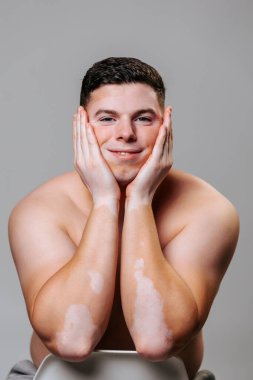 Vitiligo on the face is nothing to worry about, real people are not afraid to show their skin diseases. A young man boldly stands in the studio shows how to live with vitiligo disease. Arms on face. clipart