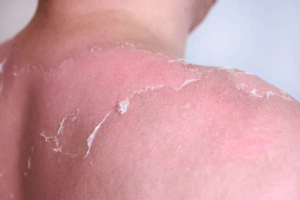 사람의 피부에 햇볕에 건조한 피부의 Exfoliation 클로즈업 — 스톡 사진