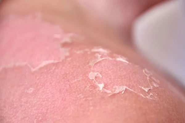 Effects Sunburn Human Skin Exfoliation Dry Skin Close — Stock Photo, Image