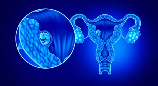 の図要素を持つ産婦人科シンボルとして女性の身体に成長している胎児としてヒト胚概念と成功した妊娠子宮内注入を注入 — ストック写真