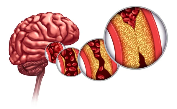 Åderförkalkning Och Stroke Som Hjärnsjukdom Som Orsakas Blodkroppar Blockeras Fett — Stockfoto