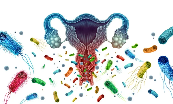 Bacterial Vaginosis Condition Vaginal Inflammation Caused Bacteria Infection Vagina Illustration — Zdjęcie stockowe