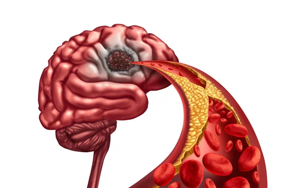 血管認知症および脳液性壊死は 動脈閉塞による脳卒中後の心への血液循環の喪失によるもので 3Dレンダリング素子を用いた組織損傷および精神機能 — ストック写真
