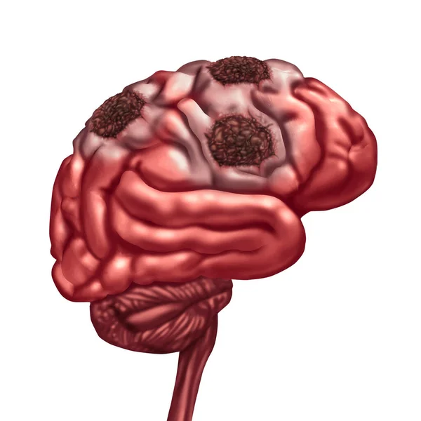 Brain Liquefactive Nekrose Durch Verlust Der Durchblutung Des Gehirns Nach — Stockfoto