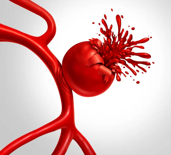 神经瘤破裂是一个医学概念 血管膨胀是一个气球状动脉 血液破裂 有出血性脑卒中的危险 — 图库照片