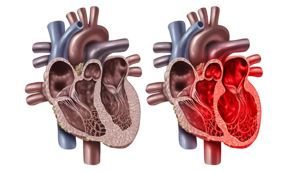 Síndrome Corazón Roto Miocardiopatía Takotsubo Con Concepto Sección Transversal Anatomía — Foto de Stock