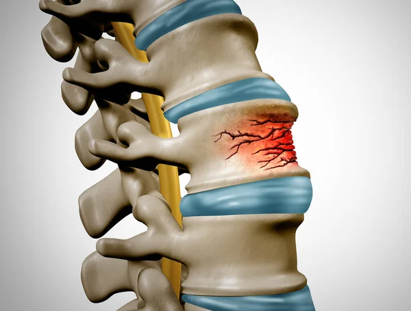 Traumatic Spine Fracture and vertebral injury medical concept as a human anatomy spinal column with a broken burst vertebra due to compression or other osteoporosis back disease as a 3D illustration.