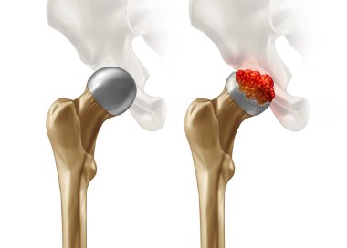 Femoral Head Disease and osteonecrosis or avascular necrosis and aseptic necrosis with a healthy hip compared to an osteoarthritis damaged pelvic joint in a 3D illustration style. clipart