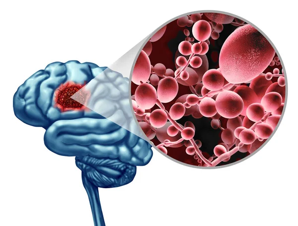 Cérebro Mortal Conceito Infecção Fúngica Como Uma Ameaça Micróbio Mucormicose — Fotografia de Stock