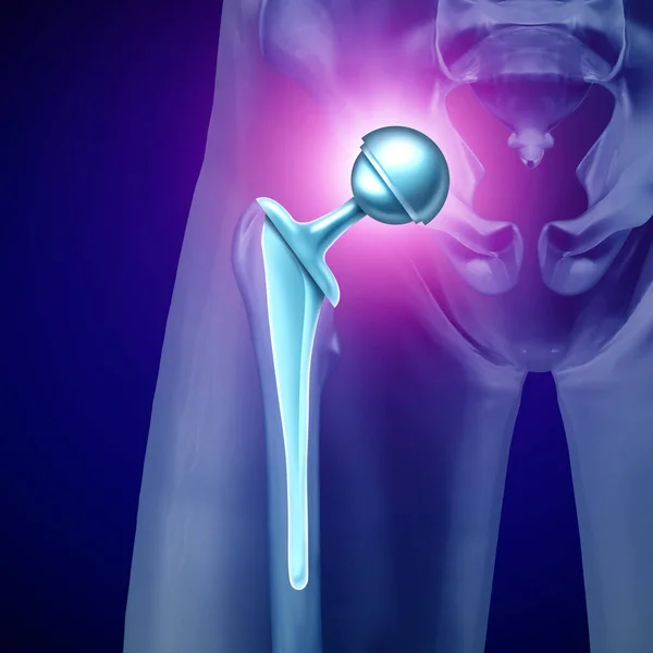 股関節置換手術の概念は 3Dイラストスタイルで疾患によって損傷を受けた女性の関節を交換するために金属ボールとソケットを挿入整形外科と人工関節や義肢として — ストック写真