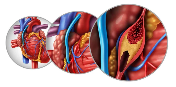 Cirugía Derivación Injerto Arteria Coronaria Cabg Como Una Obstrucción Placa — Foto de Stock