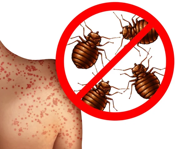 Bedbug Gryzie Ludzką Skórę Lub Koncepcji Pluskiew Inwazji Jako Powiększenie — Zdjęcie stockowe