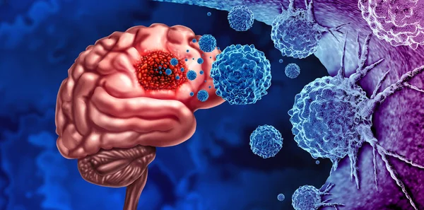 脳疾患として発生する悪性細胞としてのグリオマがん3Dイラスト要素を用いた神経疾患の医療概念としてニューロンを攻撃 — ストック写真