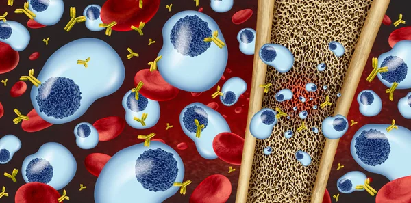 Concepto Mieloma Múltiple Cáncer Células Plasmáticas Como Crecimiento Canceroso Dentro — Foto de Stock