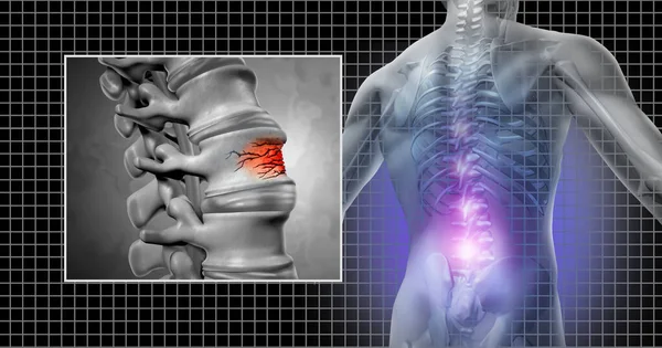 Spinal Fracture Lower Back Pain Spine Injury Vertebral Trauma Osteopathic — Stock Photo, Image