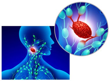 Swollen Lymph Node as an infected gland of the Lymphatic system and immune system as a swelling of the lymphoid organ infected by bacteria or virus. clipart
