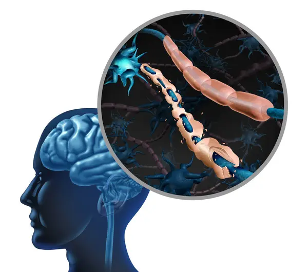 stock image Multiple Sclerosis Disease nerve disorder and damaged myelin or MS autoimmune with healthy nerve with exposed fibre with scarred cell sheath.