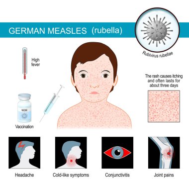 German measles. infographics about Signs and symptoms of Rubella. three-day measles is disease that caused by infection of the rubella virus. Vector illustration. clipart