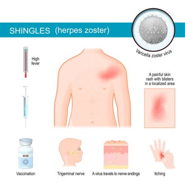 Zona. Herpes zoster belirtileri ve semptomları hakkında bilgi. Kaşındıran döküntüleri olan insan gövdesi. Varicella Zoster virüsüne yakın çekim. Virüs derideki sinir uçlarına yayılır ve kabarcıklar yaratır. Trigeminal sinir