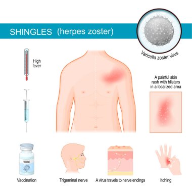 Shingles. infographics about Signs and symptoms of herpes zoster. Human torso with itching rash. Close-up of Varicella zoster virus. The virus travels to nerve endings in the skin, producing blisters. Trigeminal nerve clipart