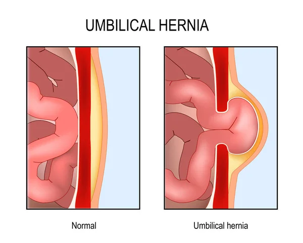 Hernia Umbilical Sección Transversal Del Abdomen Con Intestino Delgado Músculo — Vector de stock