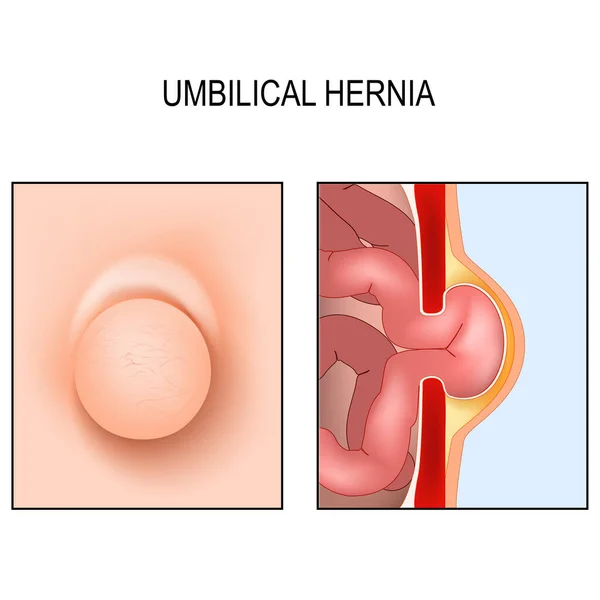 Umbilical Hernia Cross Section Abdomen Small Intestine Muscle Abdominal Wall — Stock Vector
