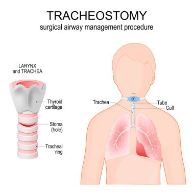 Trakeostomi. Cerrahi hava yolu yönetim prosedürü. Soluk borusunun anatomisi ve stoma. Gırtlak. Akciğerleri, soluk borusu ve bronşlu insan silueti. Soluk borusuna doğru bir trakeostomi tüpü yerleştirilmiş. vektör illüstrasyonu