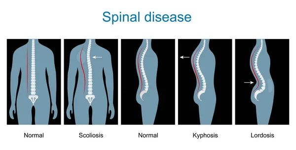脊髄疾患 脊椎の欠陥の種類です 人間の骨格と骨 縦列障害 通常の脊椎および脊椎変形性硬化症からロドシスおよびカイフォシスに X線画像のようなベクトルイラスト 内側と外側のビュー インフォグラフィック — ストックベクタ