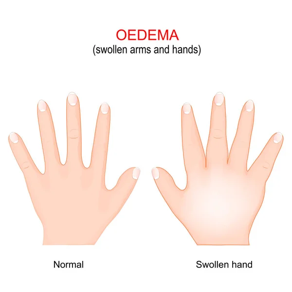 Edema 挥动胳膊和双手 水肿是身体组织中液体的堆积 矢量图解 医疗用海报 — 图库矢量图片