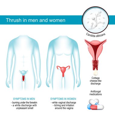Thrush in men and women. yeast infection. Vaginal candidal vulvovaginitis. infographics about Signs and symptoms of sexually transmissible disease. Close-up of fungal Candida albicans. Vector illustration. Poster for medical use clipart
